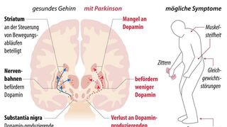 Die möglichen Parkinson-Symptome (Quelle: Deutsche Gesellschaft für Parkinson und Bewegungsstörungen).